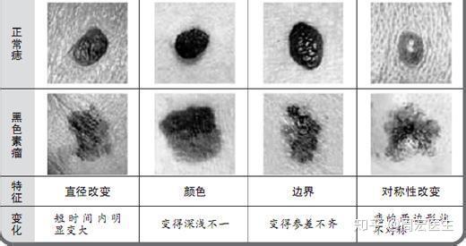 脸上身上不断长痣为什么，脸上身上总是长痣 